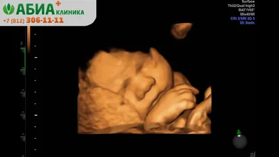 3D/4D ультразвуковое исследование при беременности