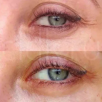 Коррекция кожи глаз препаратом МезоАй ( MesoEye) - ЦИДК