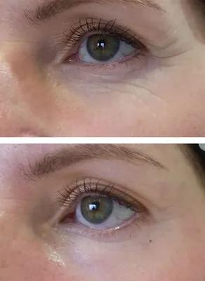 Фото 3. Эффект после препарата Meso Eye C71 до и после | Клиника  косметологии