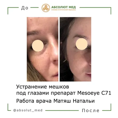Процедура Мезоай (MesoEye С71) - цена в Москве, фото до и после