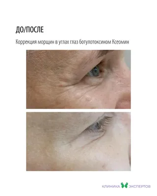 Процедура биоревитализации кожи лица и глаз цена в Москве | Телос Бьюти  проф.