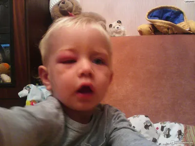 Средства для лечения аллергии UCB Farchim Зиртек - «У ребенка опух глаз,  чем мазать? Конечно же, ничем! Бегите к врачу, не занимайтесь  самолечением!» | отзывы