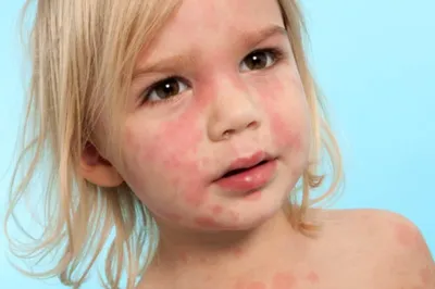 Пищевая аллергия у ребенка. Симптомы, причины и лечение