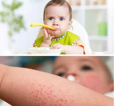 Пищевая аллергия у детей: проблемы и решения