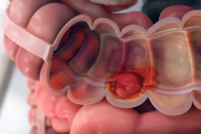 Обнаружена связь между бактериями полости рта и раком кишечника — Naked  Science