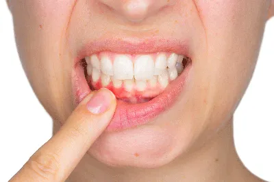 Чем полоскать рот при воспалении десны и кровоточивости десен