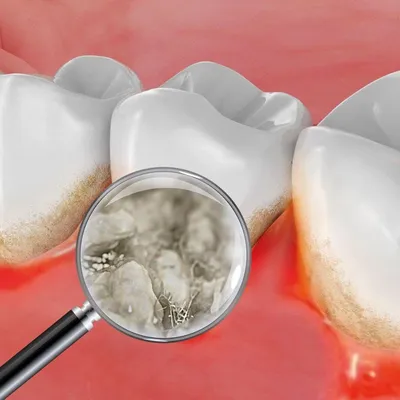 Как бактерии зубного налета могут вызвать заболевание десен | parodontax