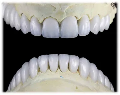 Цельнокерамические коронки E-max за 16.000 ₽ в Самаре в стоматологии Samara  Med