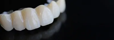 Установка зубных коронок в Краснодаре от 10 000 рублей — стоматология  «Дентал Арт»
