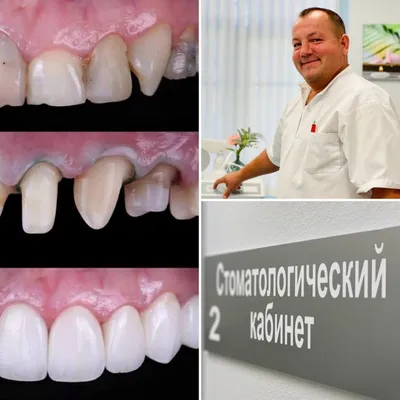 Безметалловые коронки | Презентации Ортопедическая стоматология | Docsity
