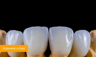 Безметалловые коронки - Ivory - стоматологическая лаборатория