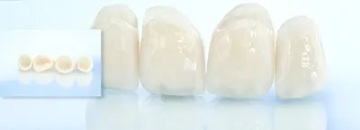 Стоимость с установкой безметалловых (фарфоровых) керамических зубов в СПб