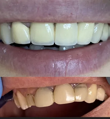 Зубные коронки - виды, какие лучше, показания, этапы установки