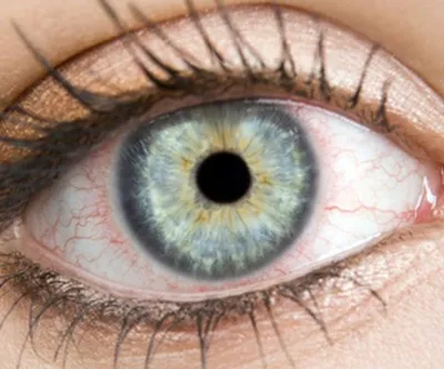 Медики рассказали, почему возникает покраснение глаз и как его лечить -  Телеграф
