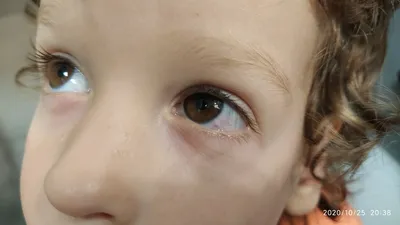 Белое пятно в толще глазного белка - Вопрос детскому офтальмологу - 03  Онлайн