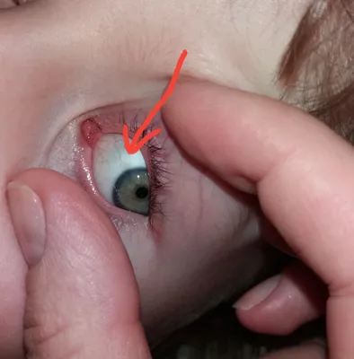 Пятно на белке глаза у ребёнка - Вопрос офтальмологу - 03 Онлайн