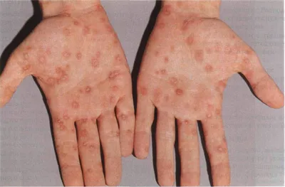 Пятна при сифилисе: как отличить от кожных сыпей.