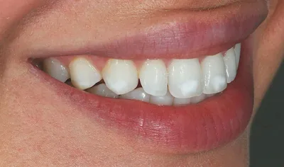 Белые пятна на зубах - что это, почему появляются, лечение и профилактика