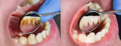 Причины появления белых пятен на зубах - Safar Medical