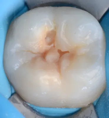 Гипоплазия эмали зубов - Семейная стоматология Дента Ареа