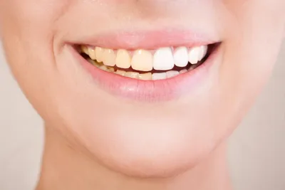 Желтые зубы: почему образуется налет и пятна на зубах ➡ denten.by