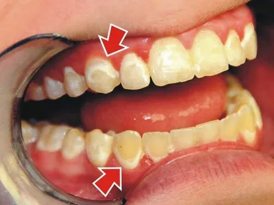 Флюороз на зубах: опасность, которую видно | Стоматологическая клиника  Слаутинского