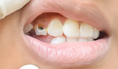 Почему появляются черные точки на зубах? - энциклопедия Ochkov.net