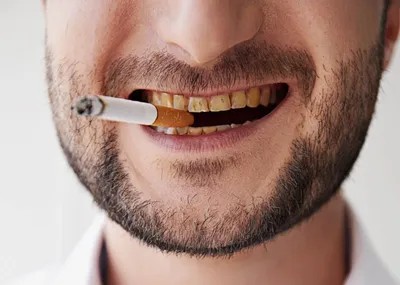 Зубные пятна от курения: как вернуть яркую улыбку?