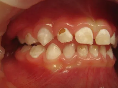 Белые пятна на зубах у ребенка: почему появляются и как убрать