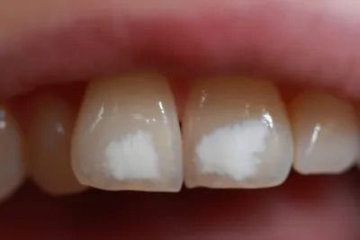 Почему на зубах появляются белые пятна. Статьи «ДОКТОР ДЕНТ».