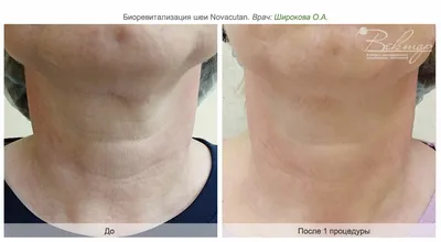 Процедура биоревитализации по выгодной цене в клинике лазерной хирургии и  косметологии «Вектор» в Москве