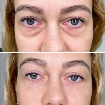 Биоревитализация кожи вокруг глаз: цены в Москве | Уколы гиалуроновой  кислоты вокруг глаз в клинике BeautyWay Clinic