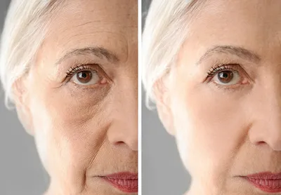Бланширование лица до и после фото