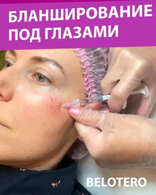 Заполнение морщинок вокруг глаз мягким, пластичным филером — vzbeauty.ru
