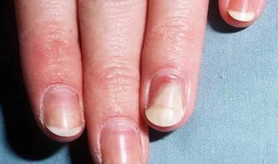 Как избавиться от онихолизиса ногтей на руках: простые рекомендации и  эффективные методы лечения
