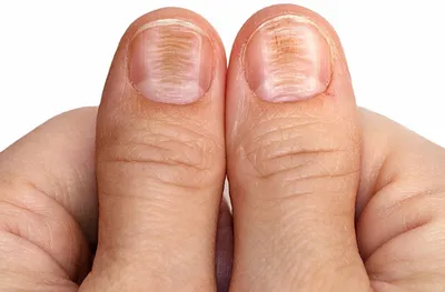 Внимание на руки: как определить серьёзные болезни по ногтям - ВашГород
