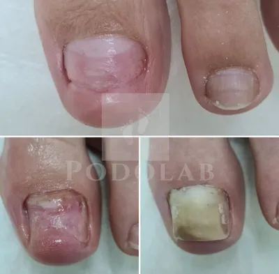 Устранение причины расщепления ногтя (онихомадезис) в Центре подологии  PODOLAB