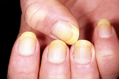 Ногти пожелтели – что это значит, симптомы, лечение и профилактика