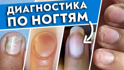 Болезни ногтей: симптомы, причины и лечение