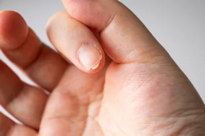 Блог :: Ломкость ногтей: причины возникновения, способы лечения
