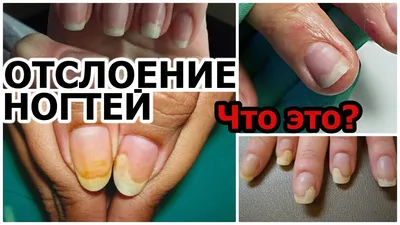 [52+] Болезни ногтей на руках с фото