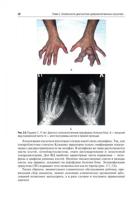 Иллюстрация 11 из 25 для Диагностика и лечение доброкачественных опухолей и  опухолеподобных заболеваний костей у детей - Морозов, Снетков, Батраков |  Лабиринт - книги. Источник: Лабиринт