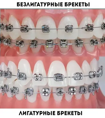 Лигатурные брекеты на зубы под ключ: особенности, преимущества, стоимость  установки | Стоматологическая клиника «Alident» в Некрасовке