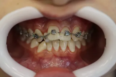 Сколько стоят металлические брекеты на зубы для детей и подростков. Цены на  брекет системы.