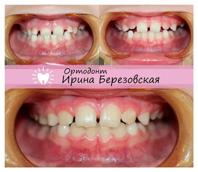 Лечение брекетами До и После | Студия улыбок Ирины Березовской