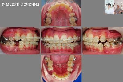 О стоматологии и не только...: Лечение брекетами. Жалко удалять зубы!