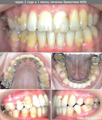 Ортодонтическое лечение на брекетах WIN с удалением зубов