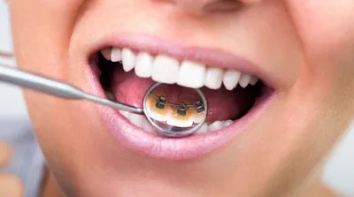 Промежуточный результат выравнивая зубного ряда брекетами за 6 месяцев.😊  Чаще всего брекеты используют для того, чтобы: ⠀ • Выровнять один или  несколько... | By Сеть стоматклиник \"Almadent\" | Facebook