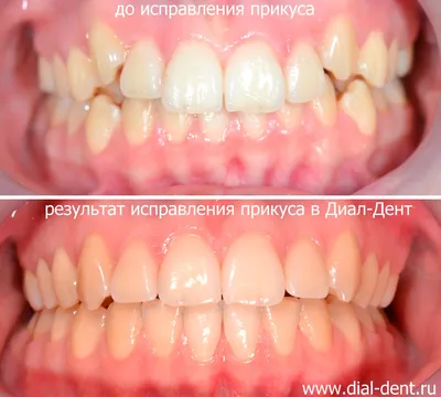 Повторное ортодонтическое лечение лингвальными брекетами WIN