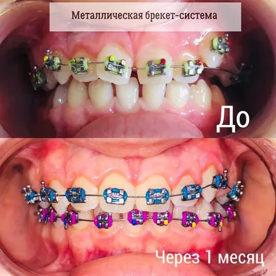 Брекет-системы | Стоматология в Запорожье Dental Studio